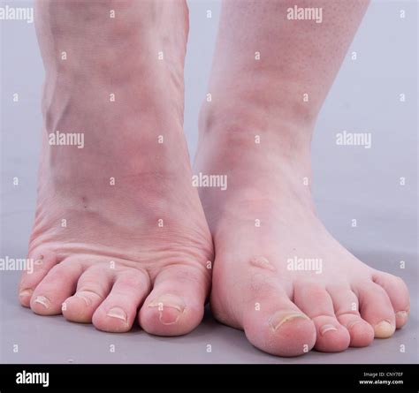 ugly feet pics|4,164 Free images of Ugly Feet